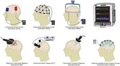 Frontiers | Non-invasive Brain Stimulation For Fibromyalgia: Current ...